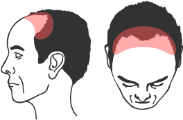 前頭部（生え際）の薄毛
