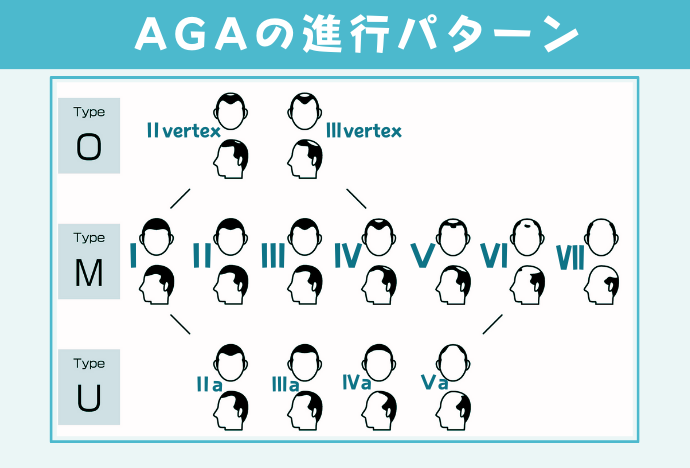 AGAの進行パターン
