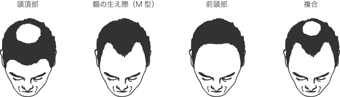 AGA（男性型脱毛症）の種類