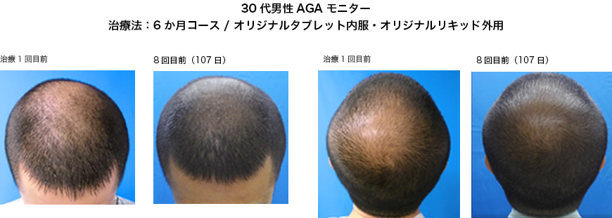30代男性AGAモニター　治療法：メソセラピー6ヵ月コース／オリジナルタブレット内服・オリジナルリキッド外用