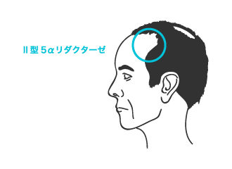 AGAはII型5αリダクターゼがテストステロン（男性ホルモン）に結合し、ジヒドロテストステロン（DHT）を産生します。