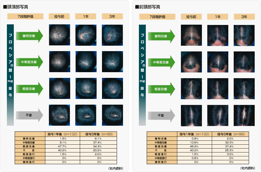 プロペシアの効果比較表