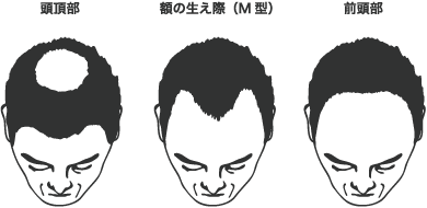 AGAパターン別進行状態