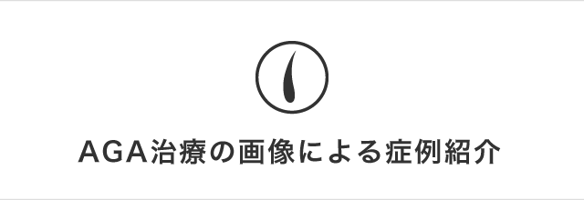 AGA治療の画像による症例紹介