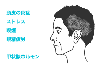 薄毛の原因