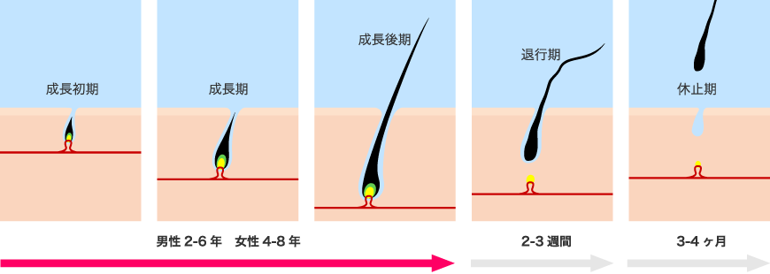 AGA治療の初期脱毛