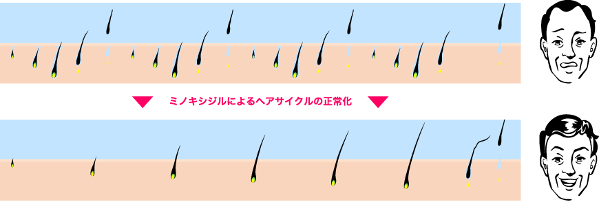 ミノキシジルによるへサイクルの正常化