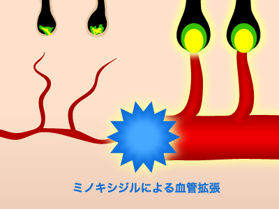 ミノキシジルによる血管拡張