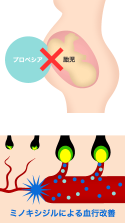 女性にプロペシアはつかえません。