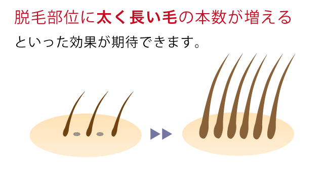 脱毛部位に太く長い毛の本数が増えるといった効果が期待できます。