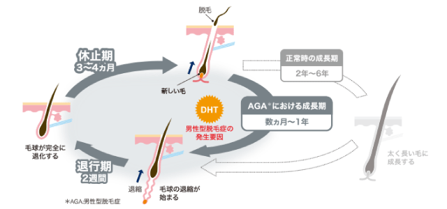 男性型脱毛症の発生原因サイクル