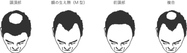 AGA（男性型脱毛症）の種類