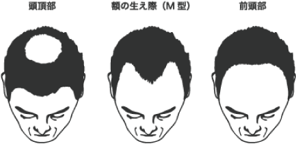 初期のAGAから症状が進行するパターンとは