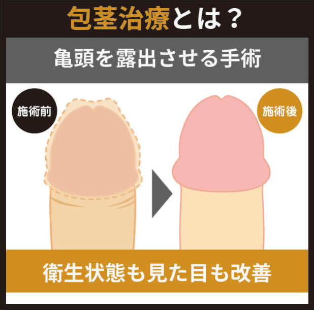 本田ヒルズタワークリニックの包茎治療