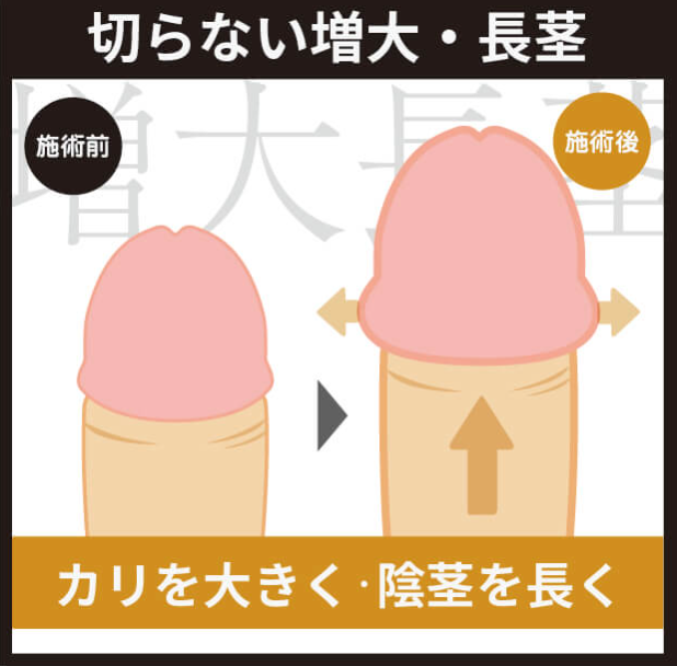 本田ヒルズタワークリニックの亀頭増大