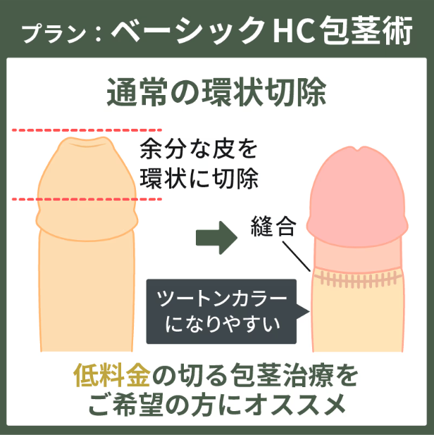 マンモスクリニックの包茎手術