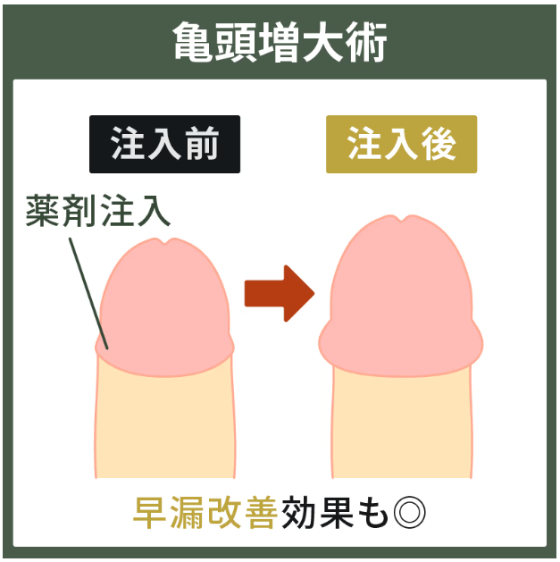 マンモスクリニックの亀頭増大