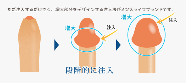 メンズライフクリニックの増大・長茎術
