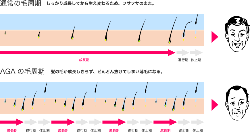 AGAは放置しておくと進行します。