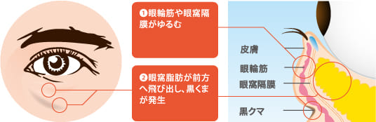 目の周りの脂肪（眼窩脂肪）が前方へ飛び出してしまうイメージ