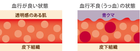 目の周りの脂肪（眼窩脂肪）が前方へ飛び出してしまうイメージ