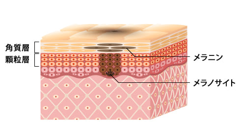 色素沈着が起きているイメージ