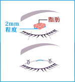 部分切開法